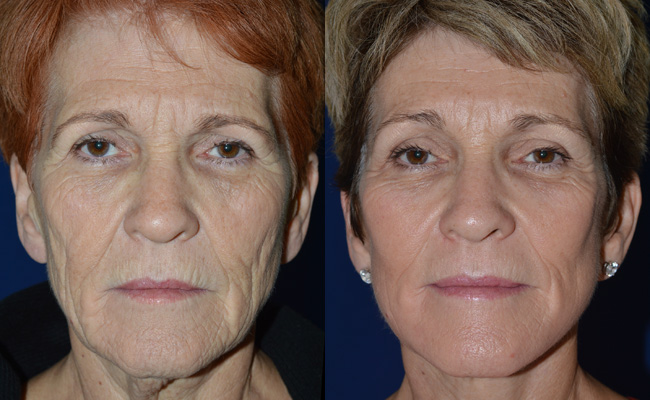 Facelift-Case-3--Facelift,-Browlift,-2940-eyes-and-mouth-BandA