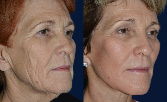 Facelift-Case-3--Facelift,-Browlift,-2940-eyes-and-mouth-BandA2