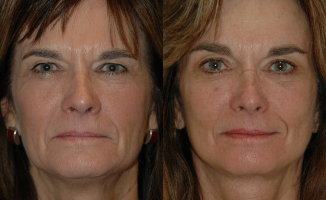 Browlifts-and-Eyes-Case-2--Browlift,-upper-and-lower-blephs,-Signature-Facelift-BandA