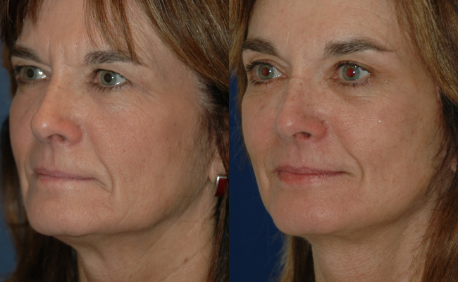 Browlifts-and-Eyes-Case-2--Browlift,-upper-and-lower-blephs,-Signature-Facelift-BandA2
