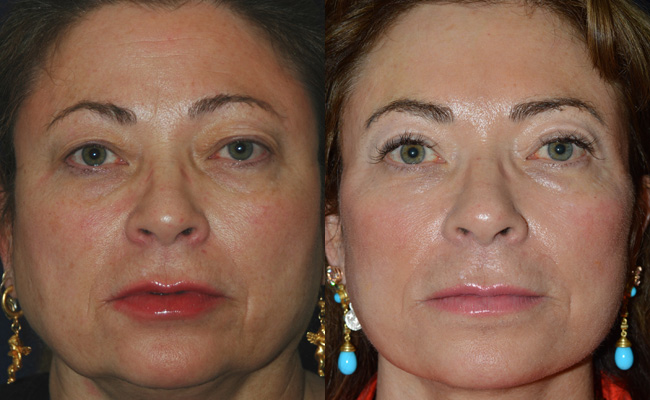 Browlifts-and-Eyes-Case-4--Browlift,-upper-blephs,-Facelift-BandA