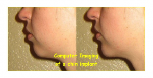 chin implant