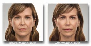 ADD VOLUME WHERE YOU NEED IT... 10% OFF Dermal Fillers (Juverderm® and Restylane® products)