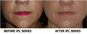 fillers-before-after