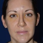 One Week After Rhinoplasty - Denver Facelift Specialists