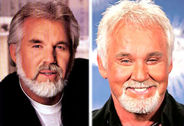 Kenny Rogers Before and After Facial Plastic Surgery What Went Wrong?